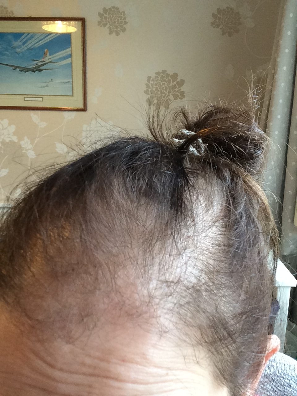 My hair loss journey - Her Hair My Head